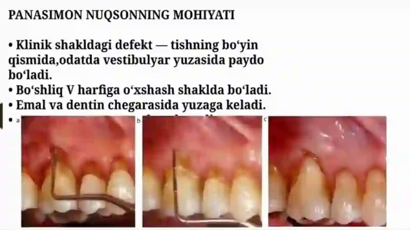 Nokarioztishshkastlanishlar, tish chiqqandankeginyuzaga keladigan.Ponasimonnuqson 4