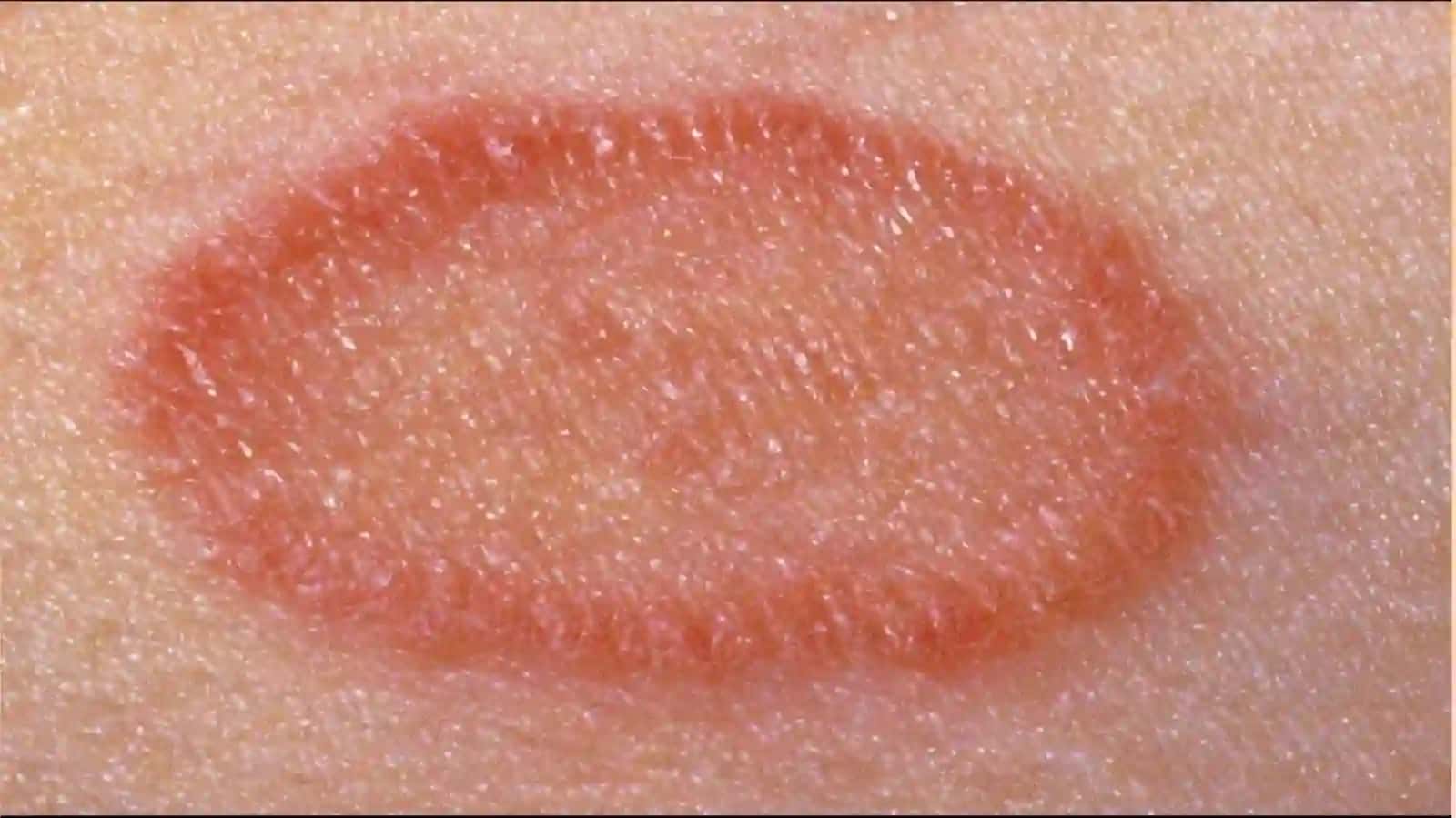 Jiberning pushti temiratkisi (Pityriasis rosea) 4