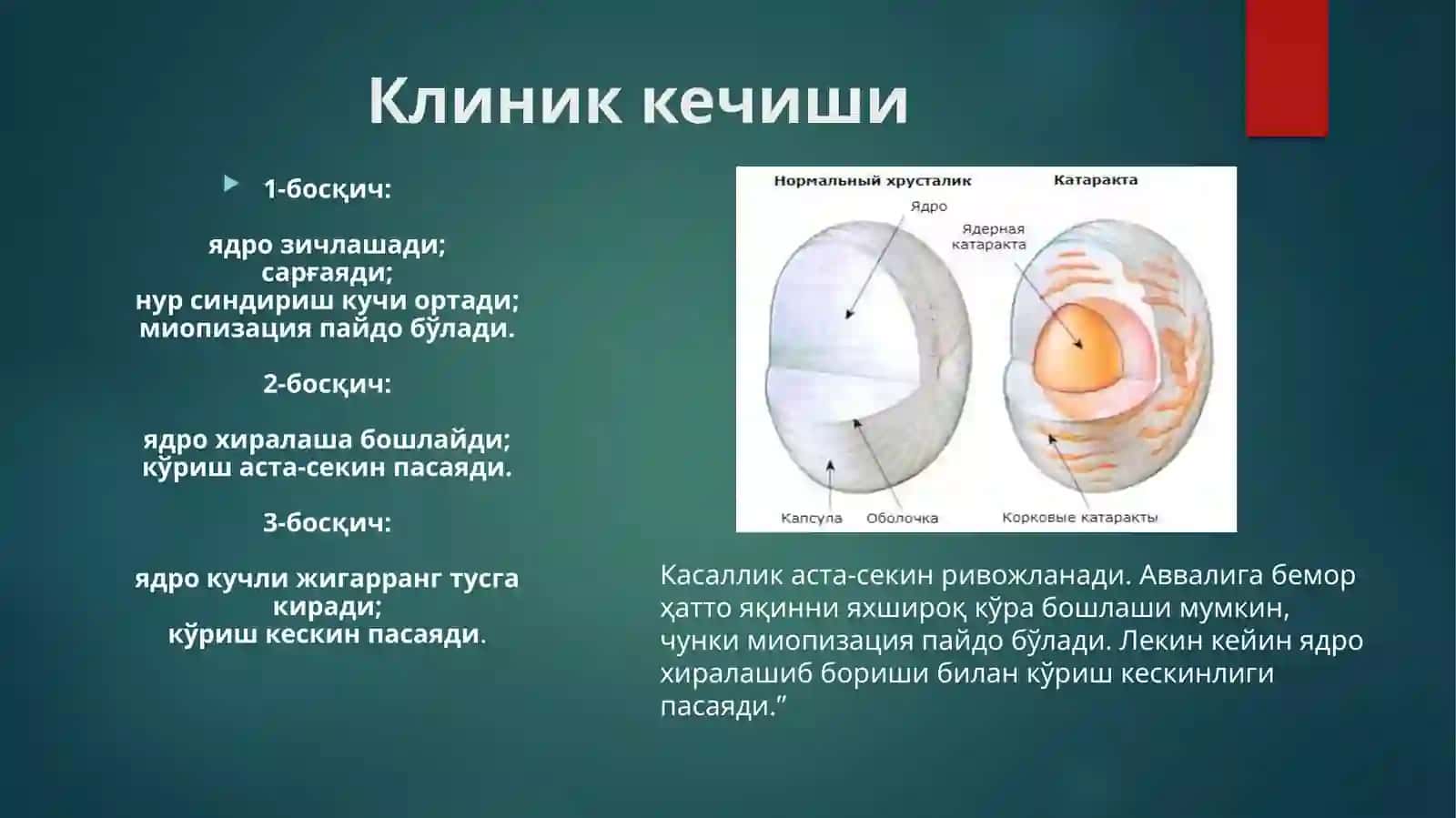 Ядроли катаракта 4