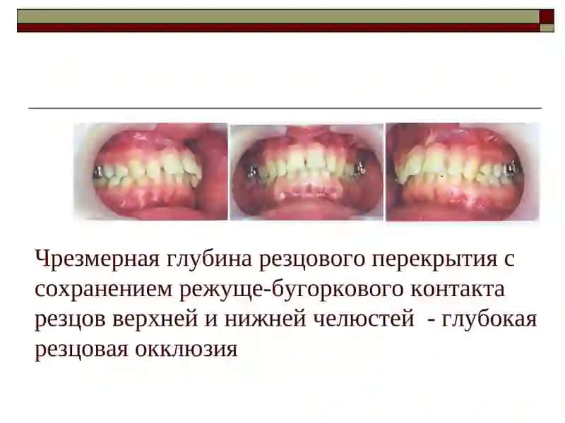 Глубокий прикус 4