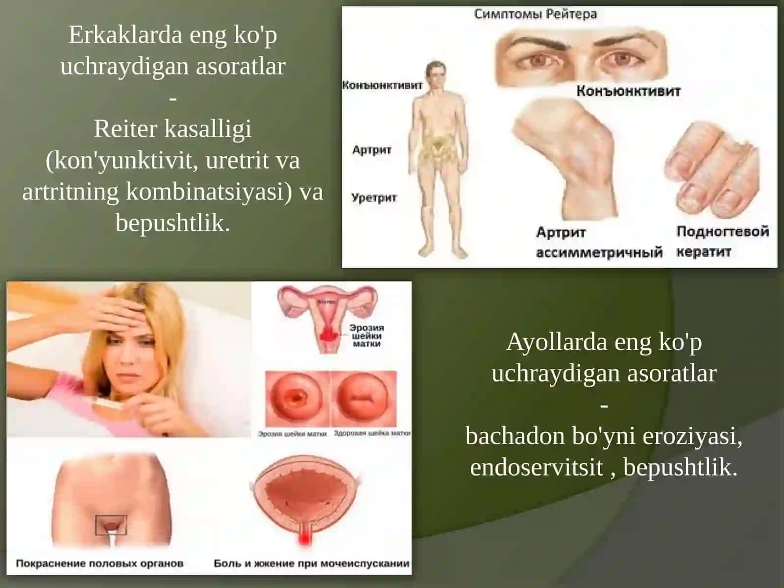 Jinsiy yo'l bilan yuqadigan kasalliklar.Xlamidiya 4