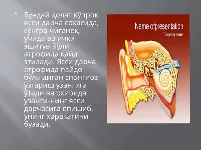 Otoskleroz 4