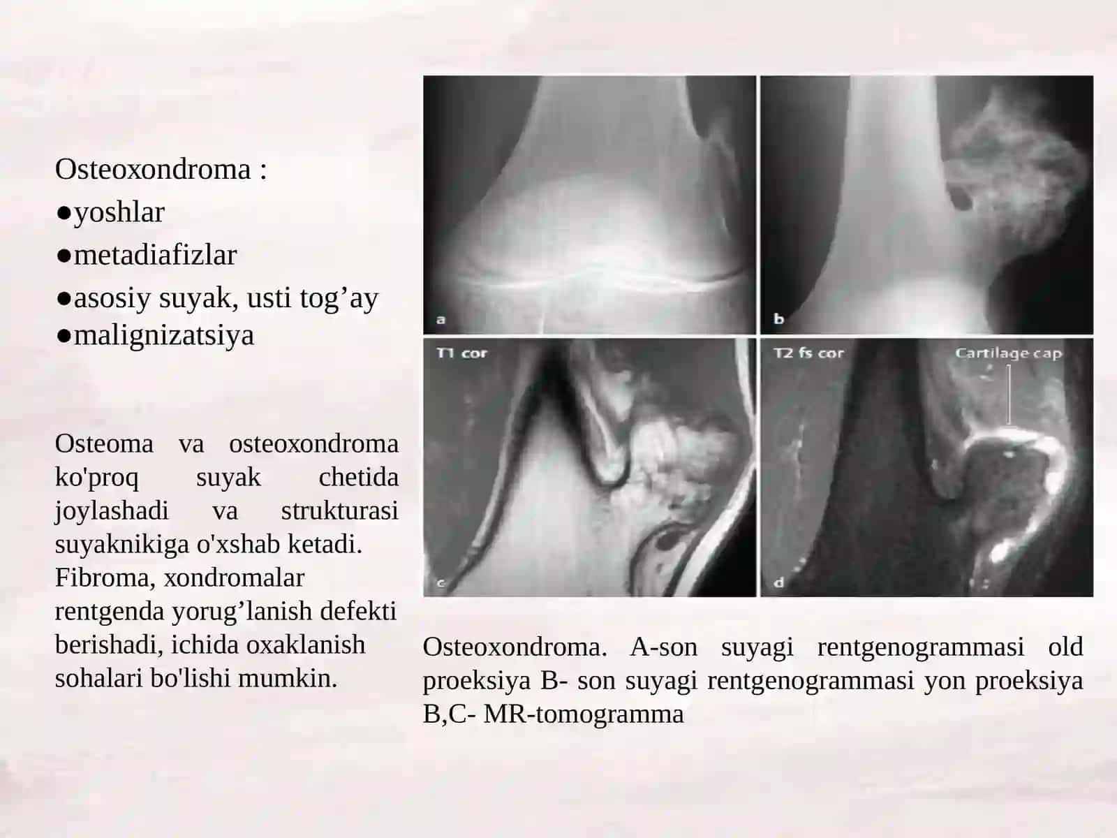 Suyakning xavfsiz o'smаlаri(оstеоmа, хоndrоmа, оstеохоndrоmа, fibrоmа, gеmаngiоmа) 4