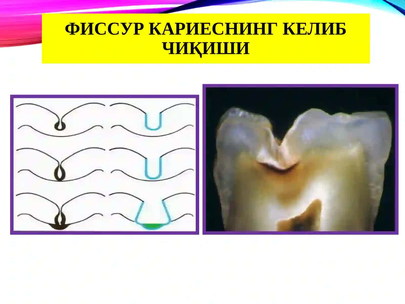 Тиш кариеси: қийосий ташхиси 4