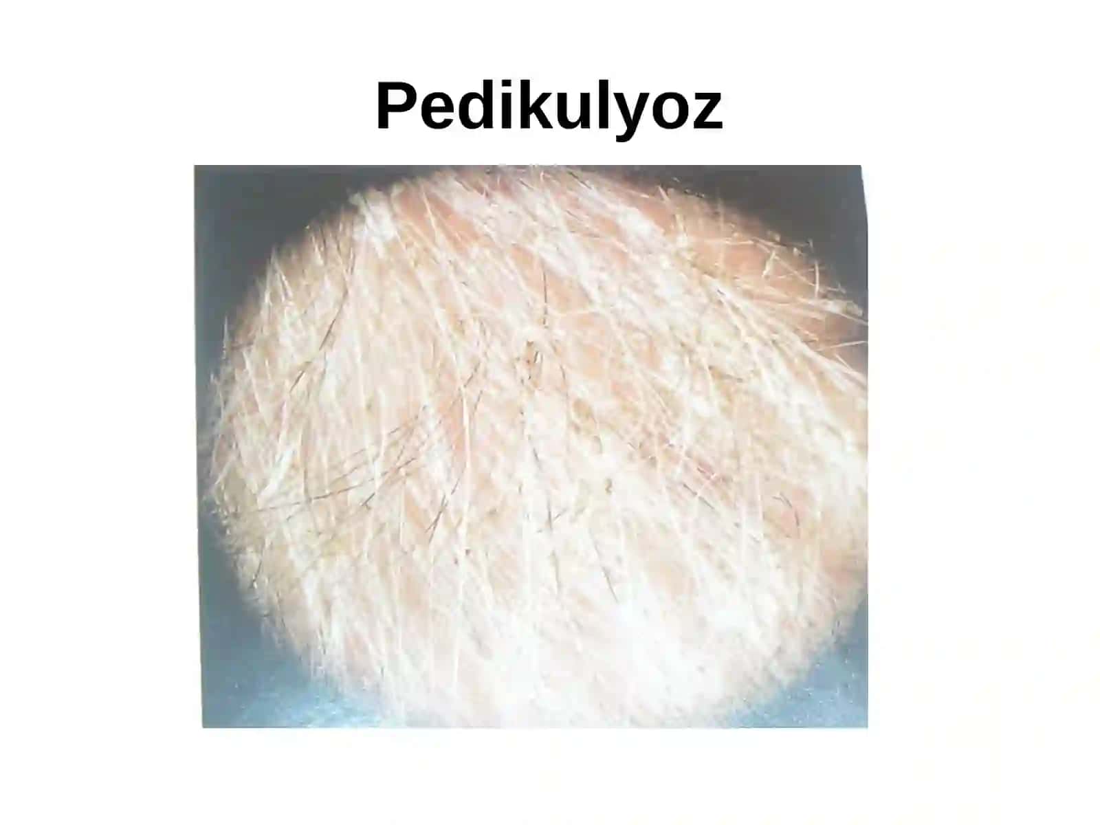Bitlash (pedikulyoz) 4