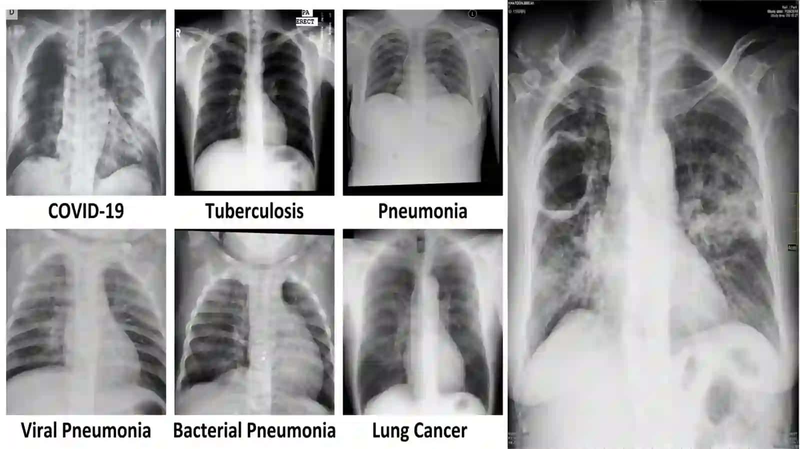Tuberkulyoz klinik shakllarini qiyosiy tashxislashning asosiy usullari 4