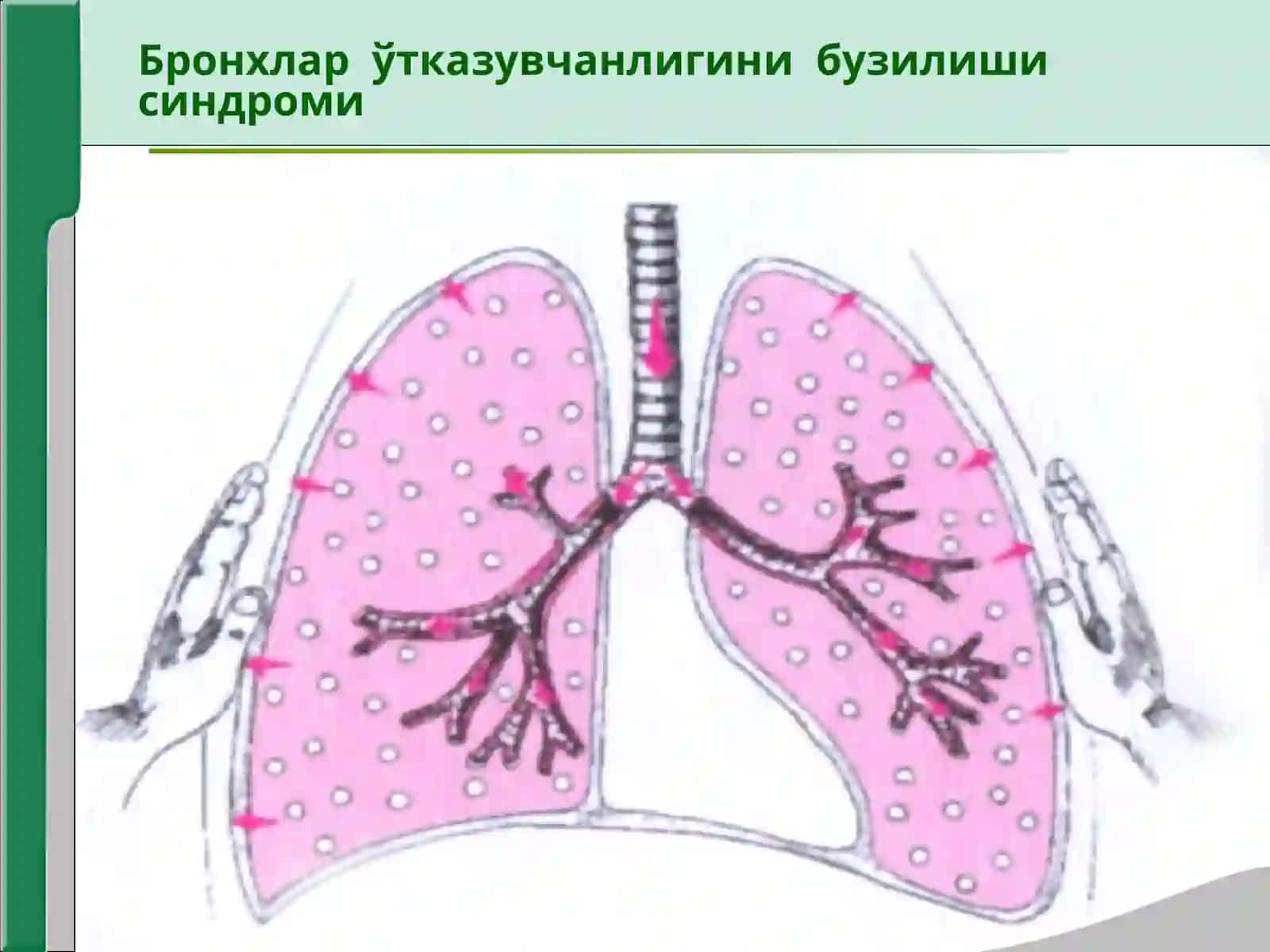 Нафас органлари касалликларида асосий клиник синдромлар Бронхлар ўтказувчанлигини бузилиши ўпка тўқимасида ҳавони ортиб кетиши синдроми 4
