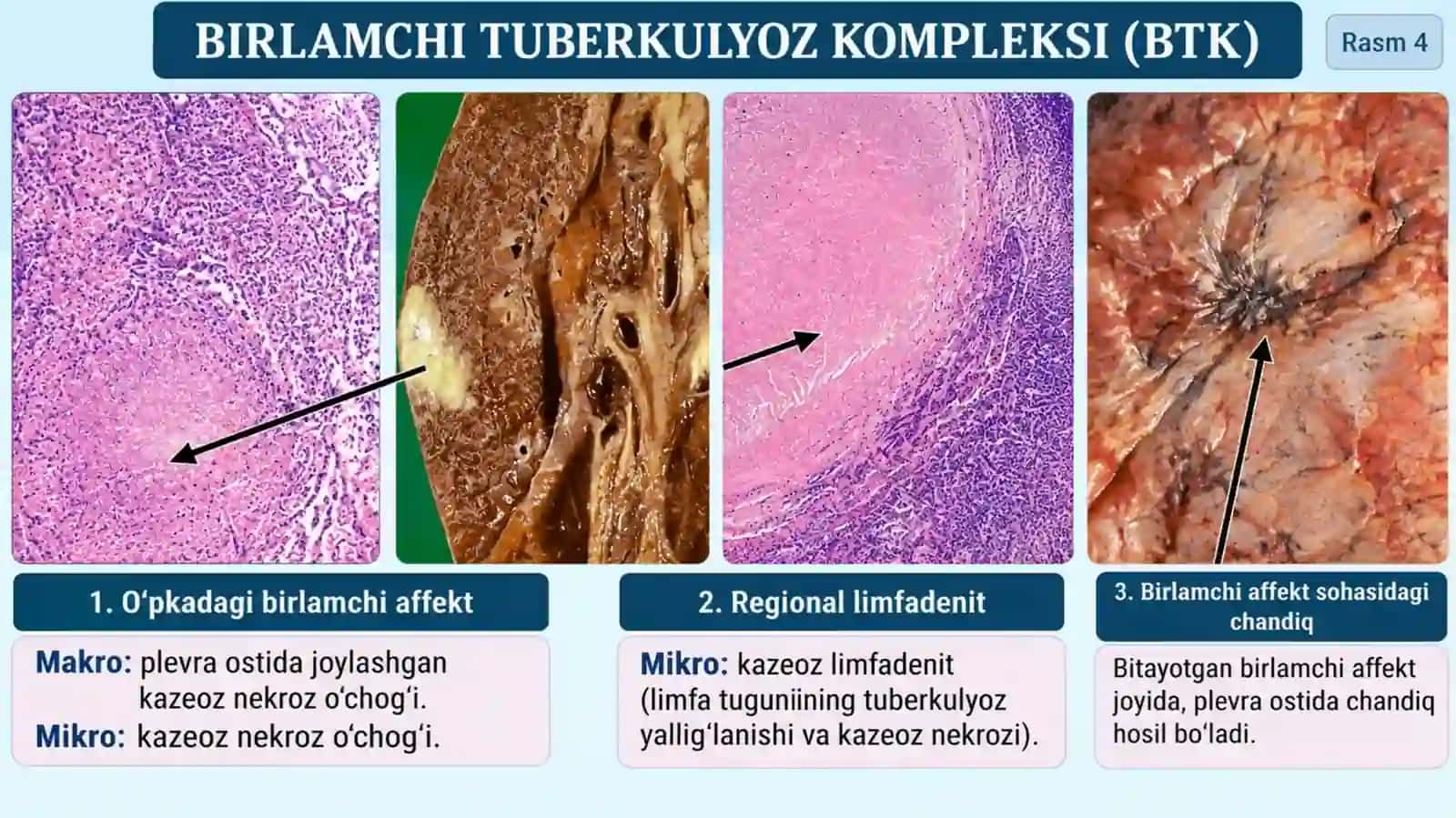 BIRLAMCHI TUBERKULYOZ 4