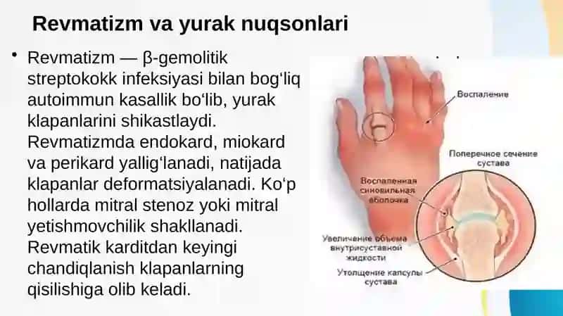 Yurak nuqsonlarining revmatizm, infeksion endokardit va aorta aterosklerozi kasalliklarida rivojlanish sabablari. EKG va rentgenologik tekshiruvdagi belgilari va davolash usullari. Aortal yurak nuqsonlarining etiologiyasi, patogenezi, klinikasi va diagnostikasi 4