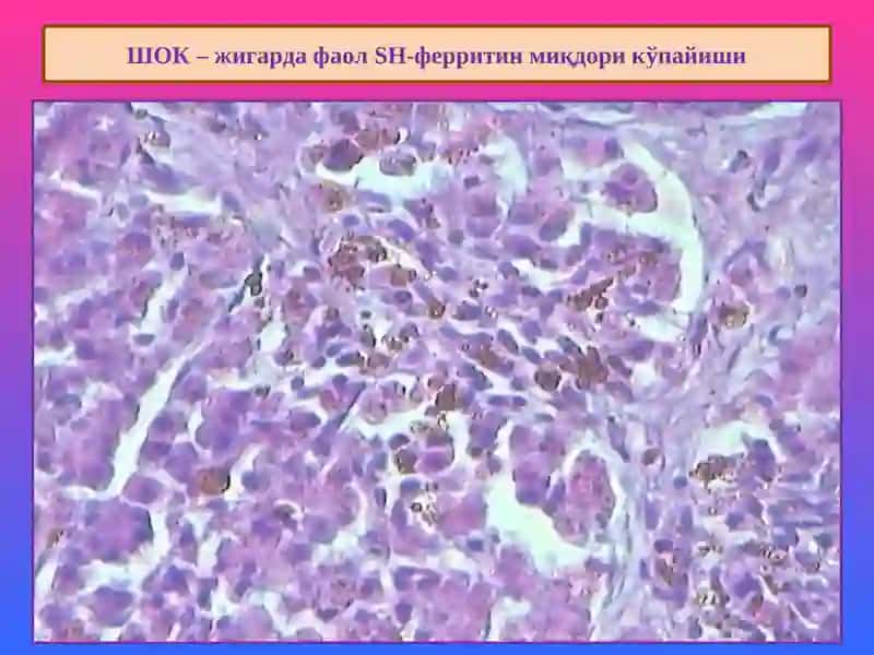 Аралаш дистрофиялар 4