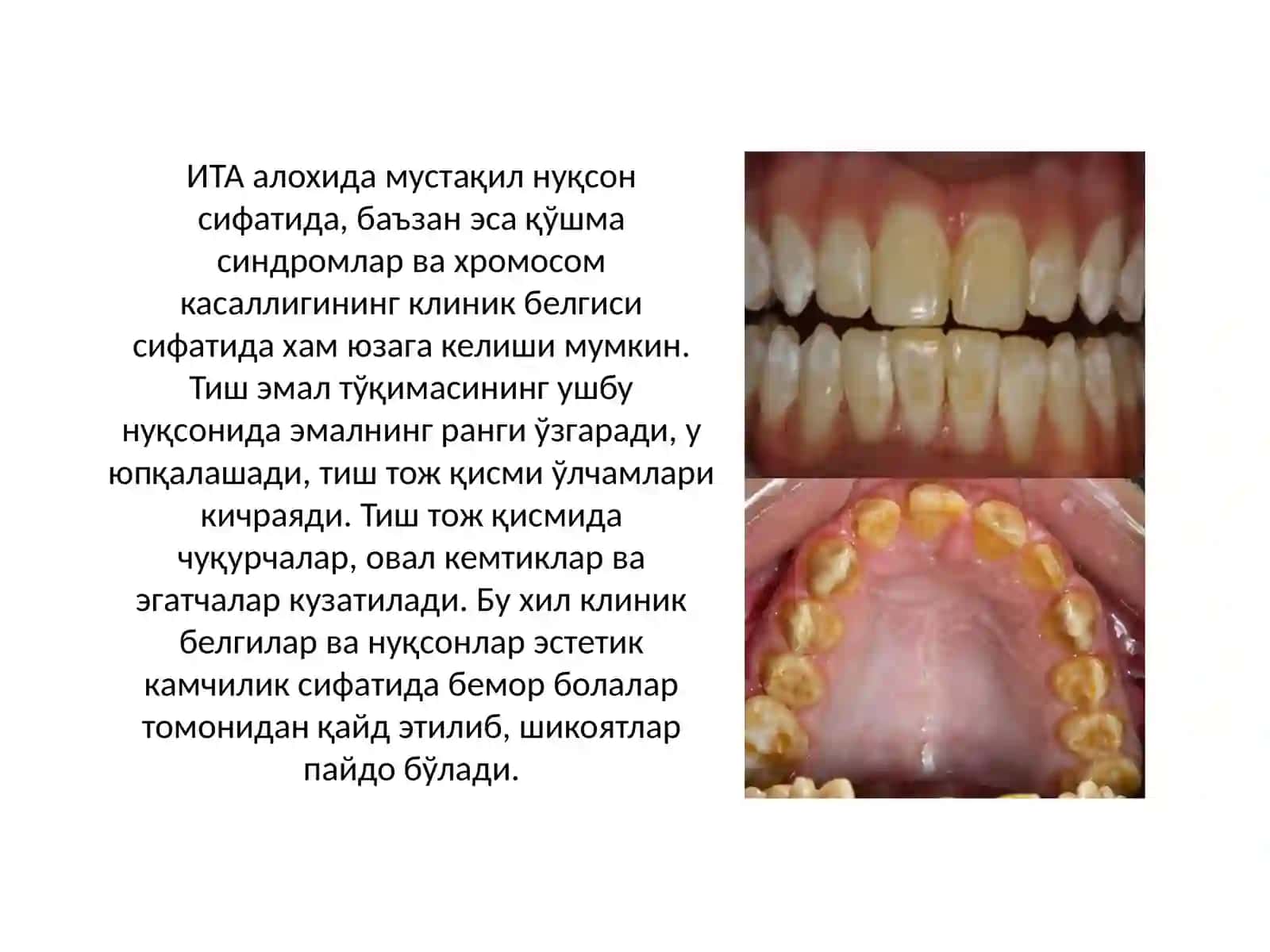 ИРСИЙ ТУГАЛЛАНМАГАН АМЕЛОГЕНЕЗ(ИТА) 4