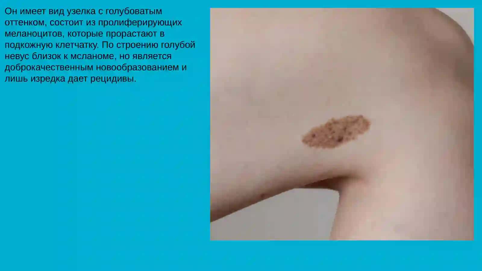 Меланом зубочелюстной системы, их морфология 4