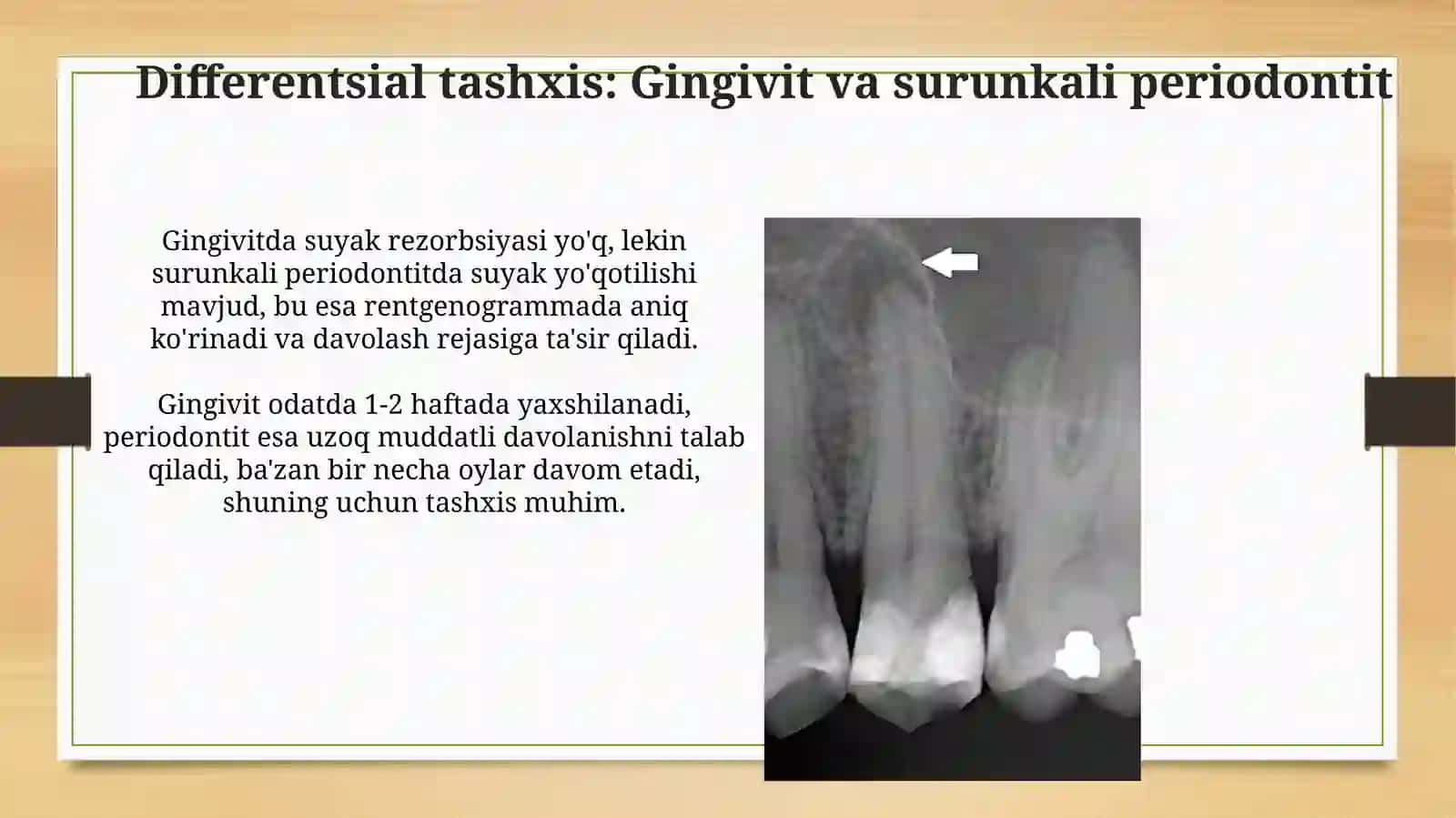 O‘tkir periodontitlarning o‘ziga xos klinik kechishi, qiyosiytashxisi 4