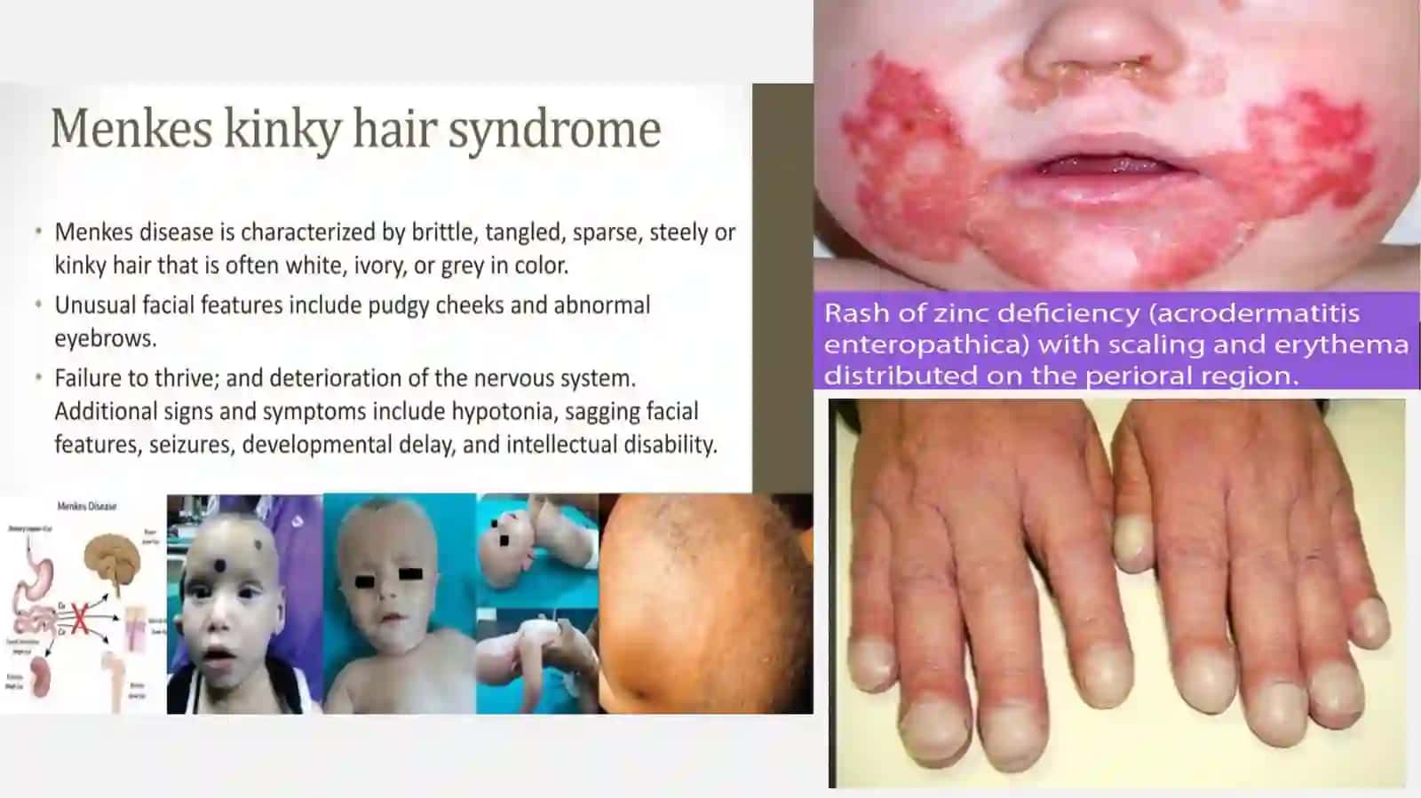 Malabsorbsiya sindromi — 30 slaydli taqdimot | Nelson Pediatrics 4