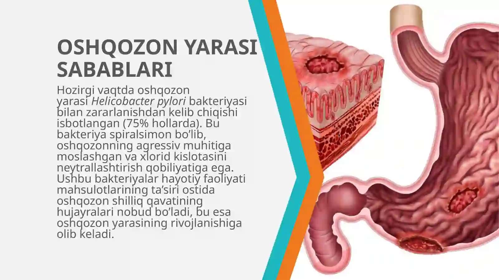Oshqozonning yara kasalligi etiopatogenezi 4