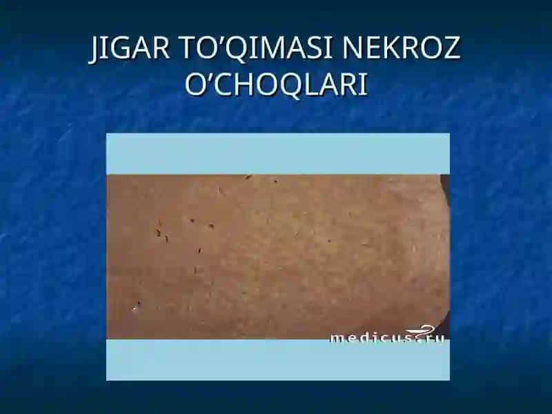 Jigar sirrozi 4