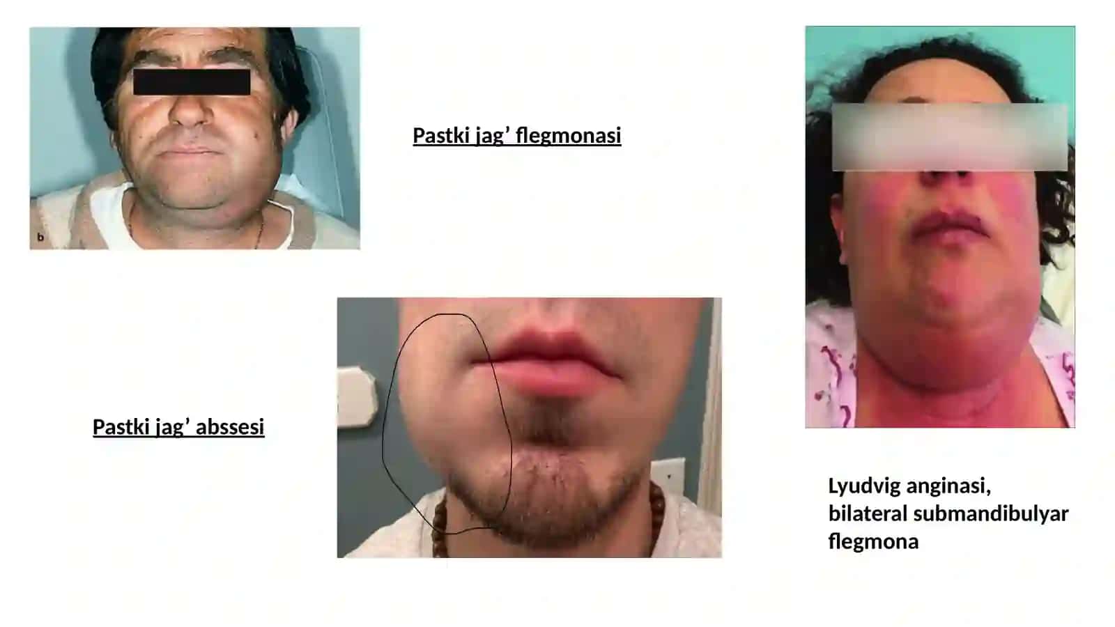 Og’iz tubi flegmonasi. Lyudvig anginasi 4