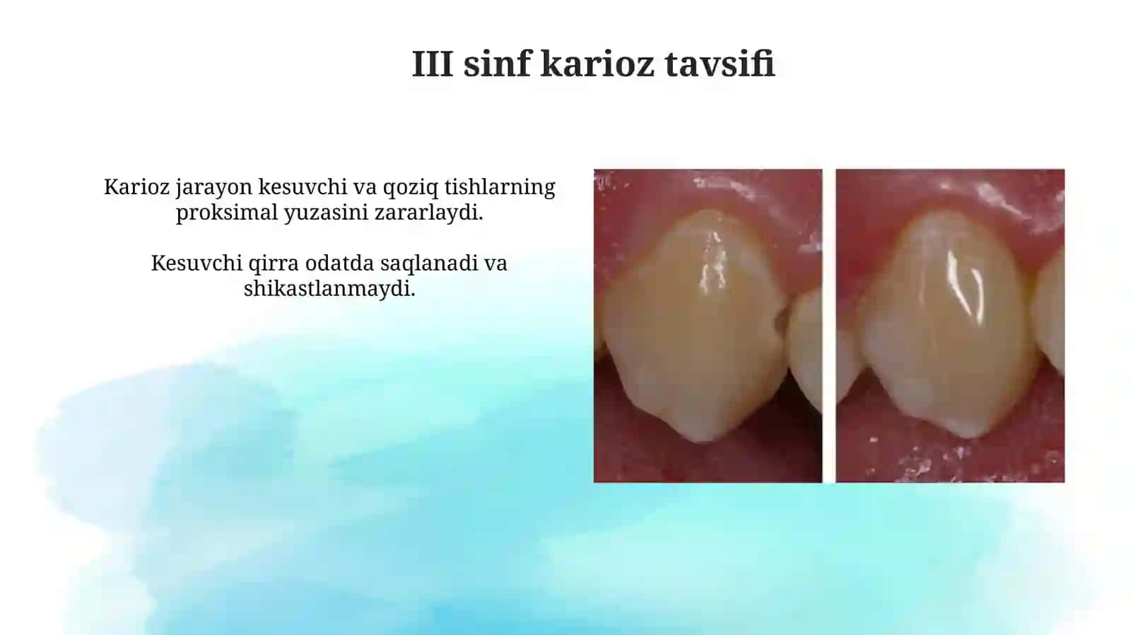 Fantomlarda III sinf karioz bo'shliqlarini charxlash va plombalash 4