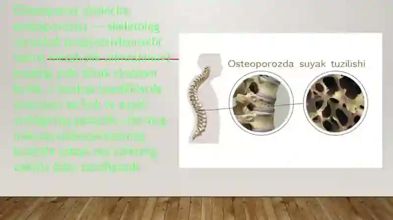 Osteoporoz kasalliklari 4