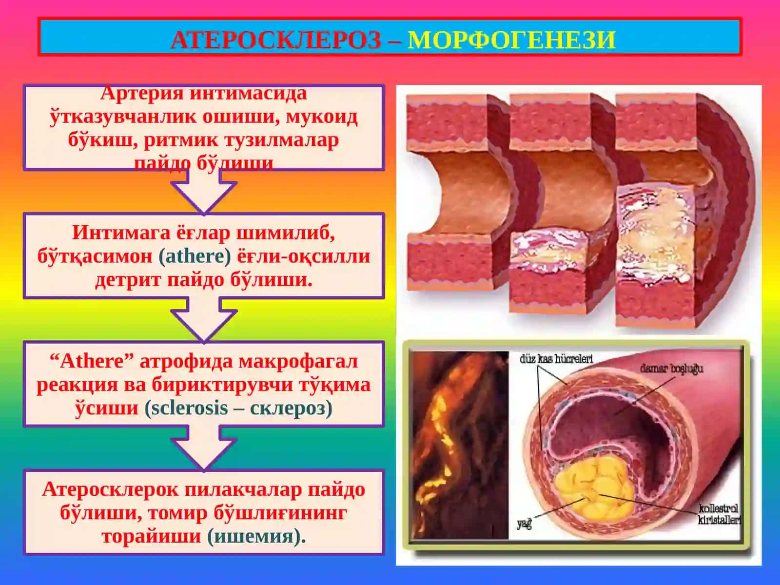Атеросклероз. Гипертония касаллиги 4