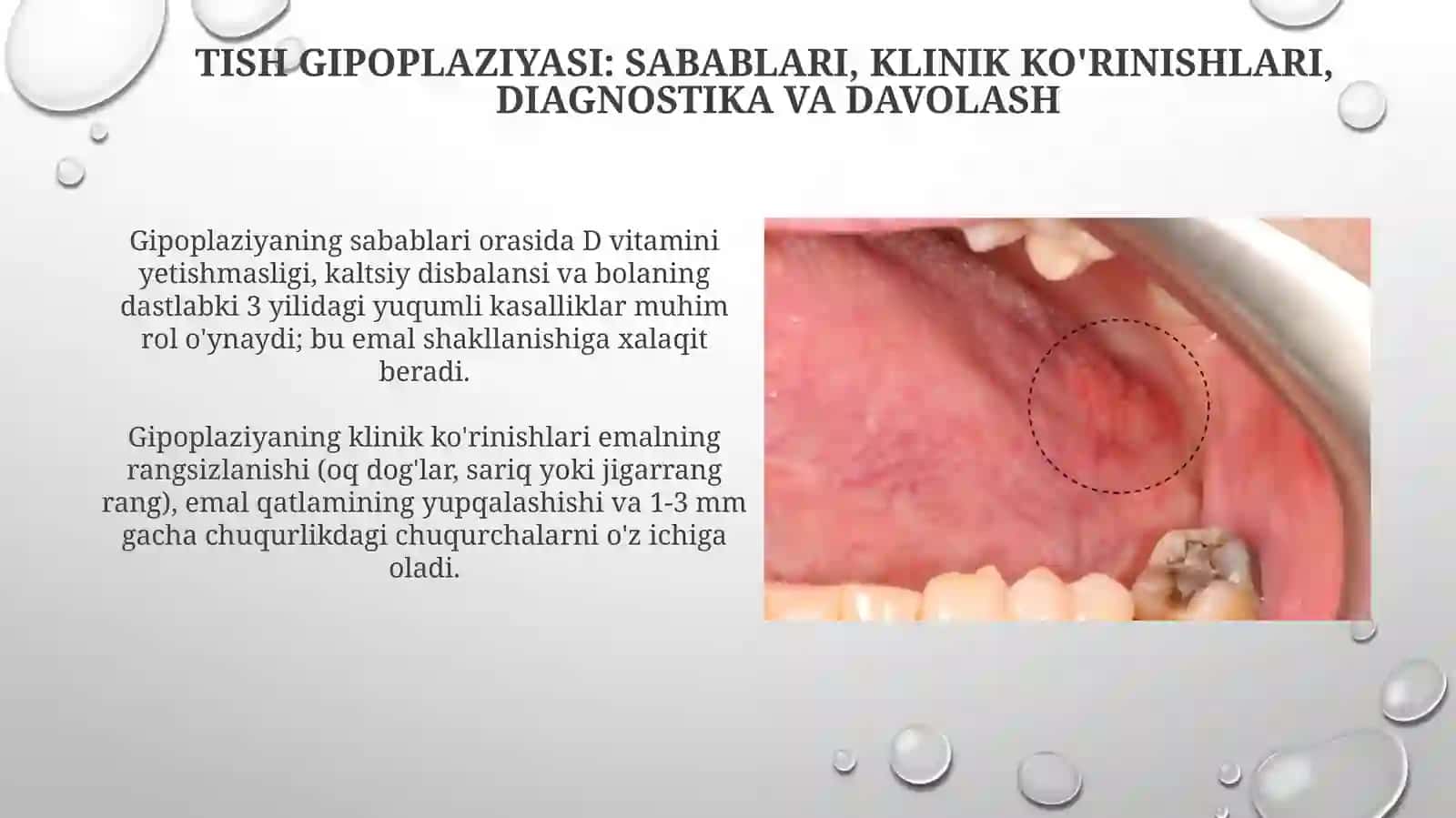 Follikulyar rivojlanish davrida tish to'qimalarining shikastlanishi: Gipoplaziya va Giperplaziya 4