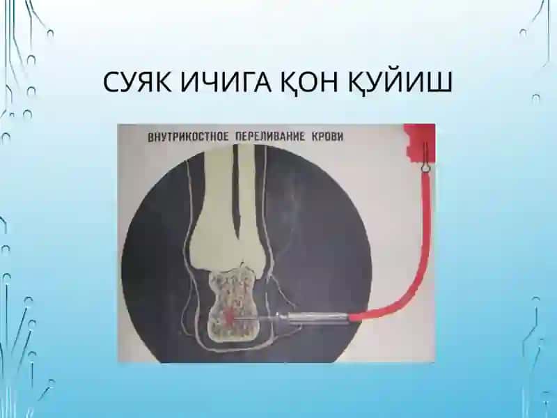 Qonquyishturlarivausullari.Sitratlizaharlanish:sabablari,tashxisi. 4