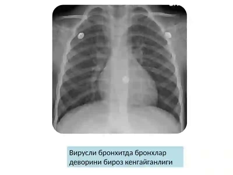 Уткир бронхит 4
