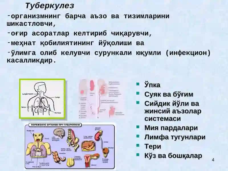 Туберкулез 4