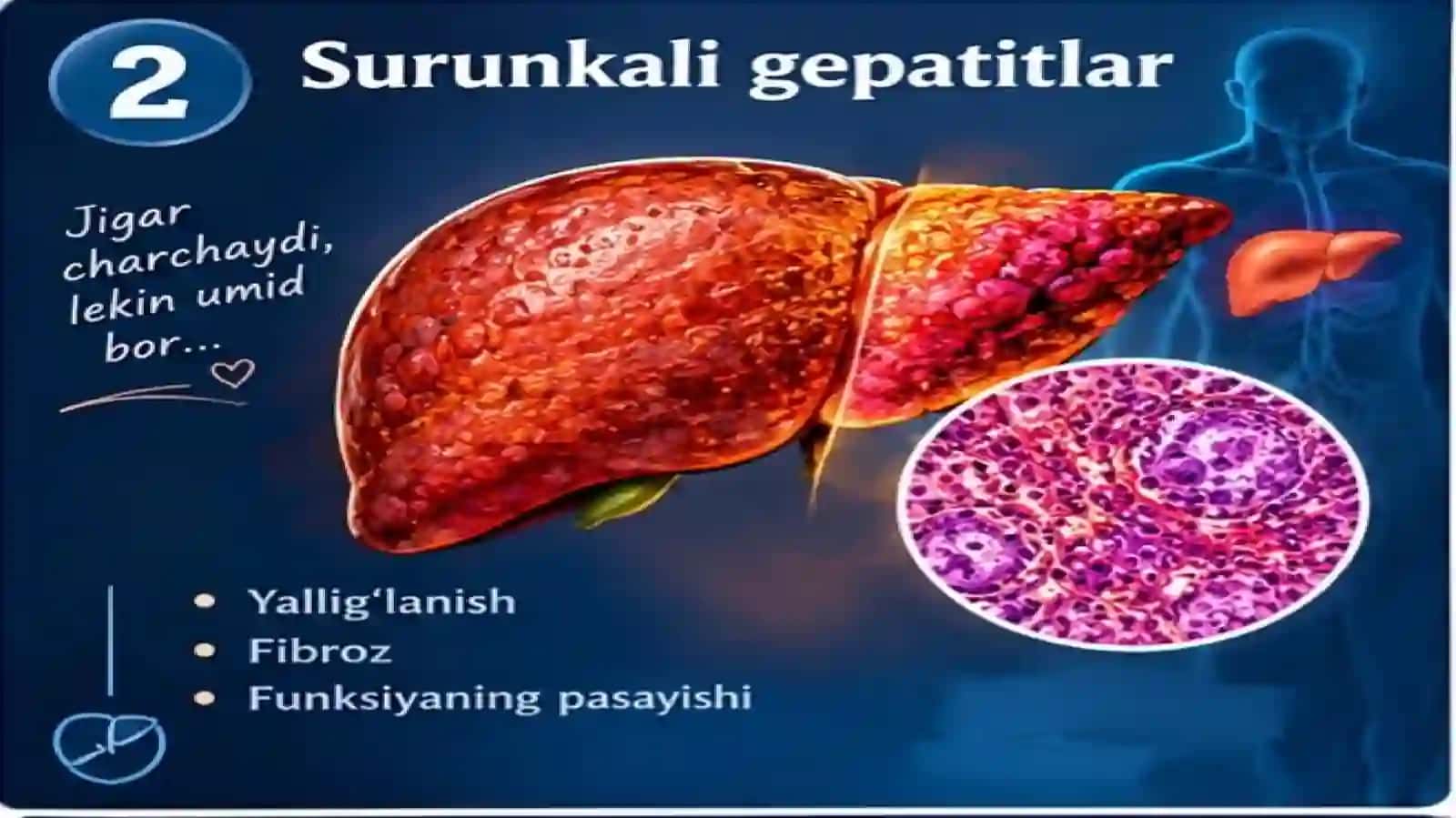 Surunkali gepatitlar. Xolesistitlarda yog'lar hazmlanishini buzilishi(steatoreya).Yog' kislotalarini 4
