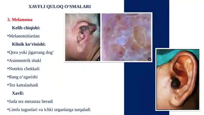 QULOQNING XAVFLI O‘SMALARI 4