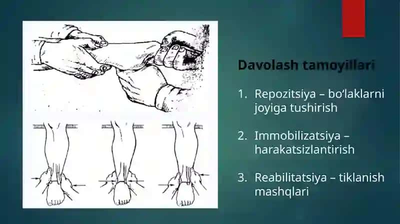 Oyoq-qo‘llar sinishlarni yopiq repozitsiyasi. Gips texnikasi. (Gips xonada ishlash). Skelet va leyko 4