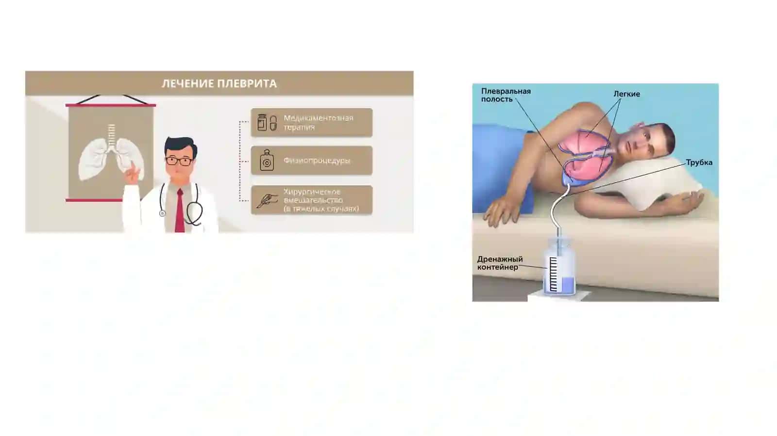 Plevritlar etiologiya, patogenez, patomorfologiya, xarakterli simptomlari. Unda og'iz bo'shlig'ida o'ziga xos o'zgarishlar parhez va medikamentoz davolash. O'pka emfizemasi: etiologiya, patogenez, patomorfologiya, xarakterli simptomlar, og'iz bo'shlig'ida oʻziga xos o'zgarishlar, parhez va medikamentoz davolash. 4