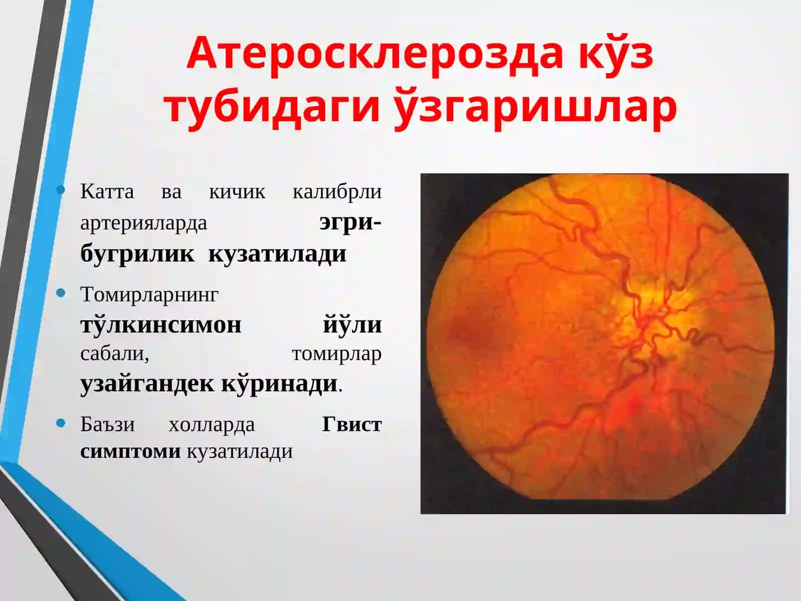 Умумий касалликларда кузатиладиган кўздаги патологик ўзгаришлар 4