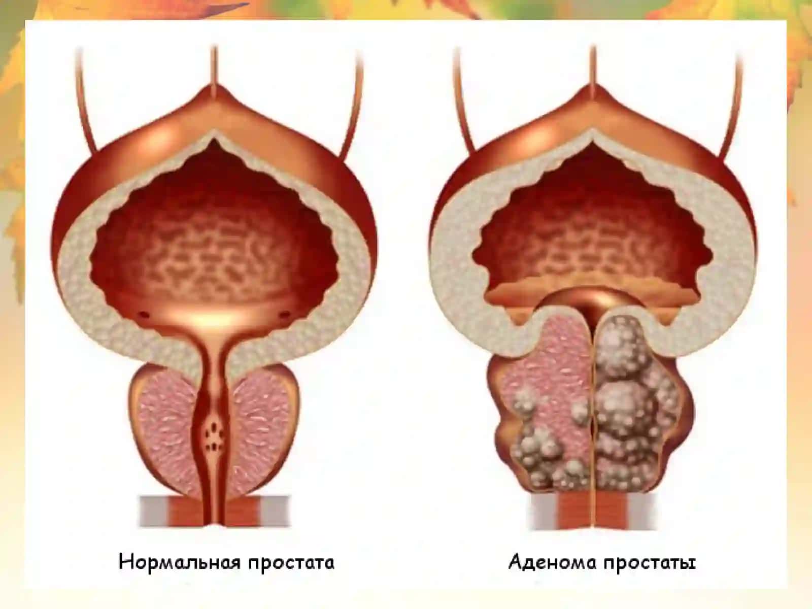 Prostata bezi o'smalari 4