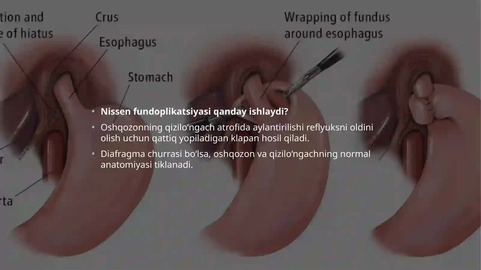 Diafragma churrasida nissen bo'yicha fundoplikatsiya amaliyoti 4