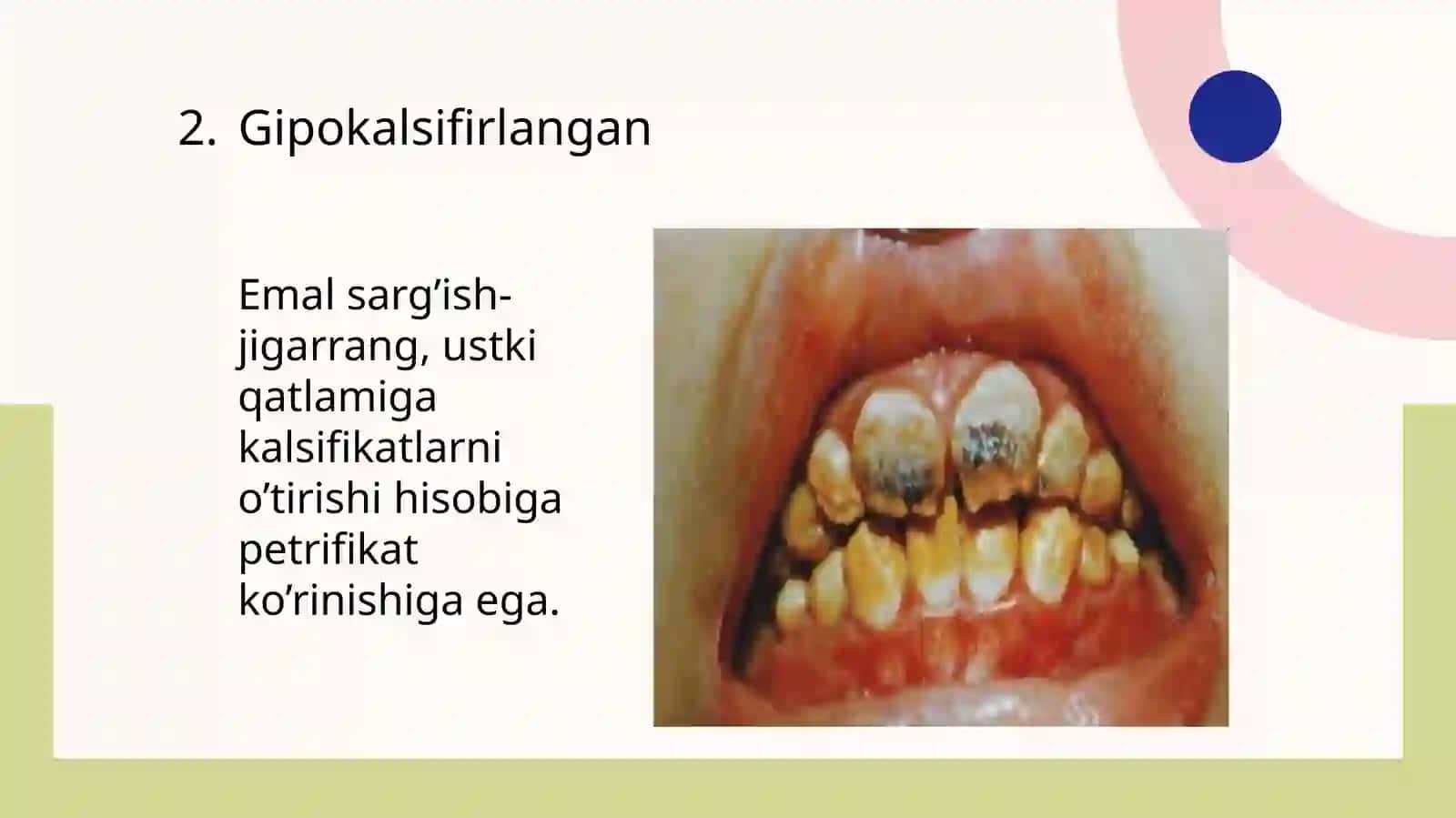 Tishqattiq to'qimasining nasliy kasalliklari 4