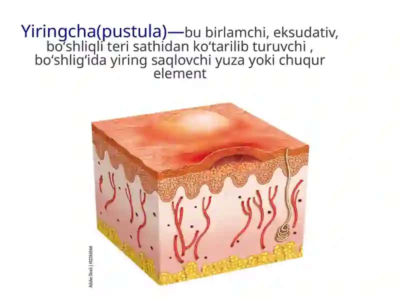 Stafilodermiya 4