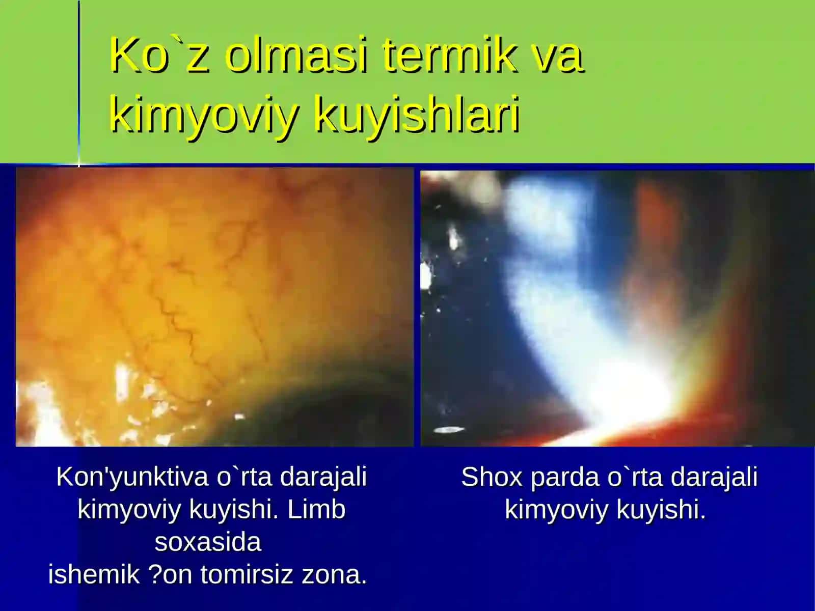Ko`z olmasi termik va kimyoviy kuyishlari 4