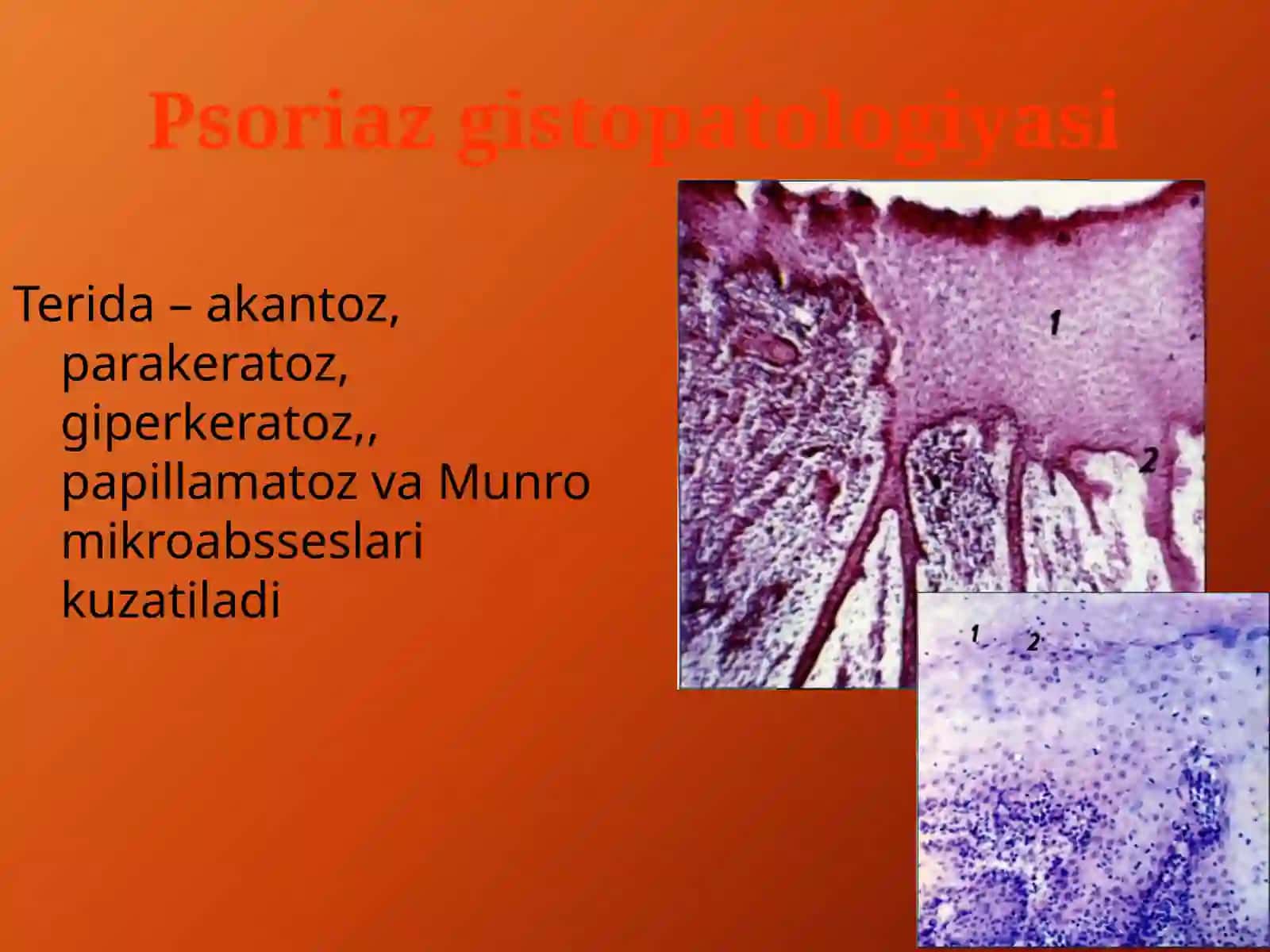 Psoriaz va QIZIL YASSI TEMIRATKINING A TIPIK TURLARI 4