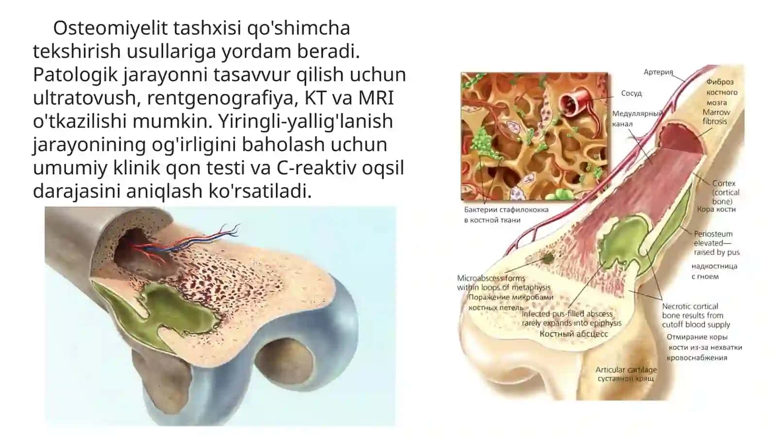 Gematogenli ostemielit 4