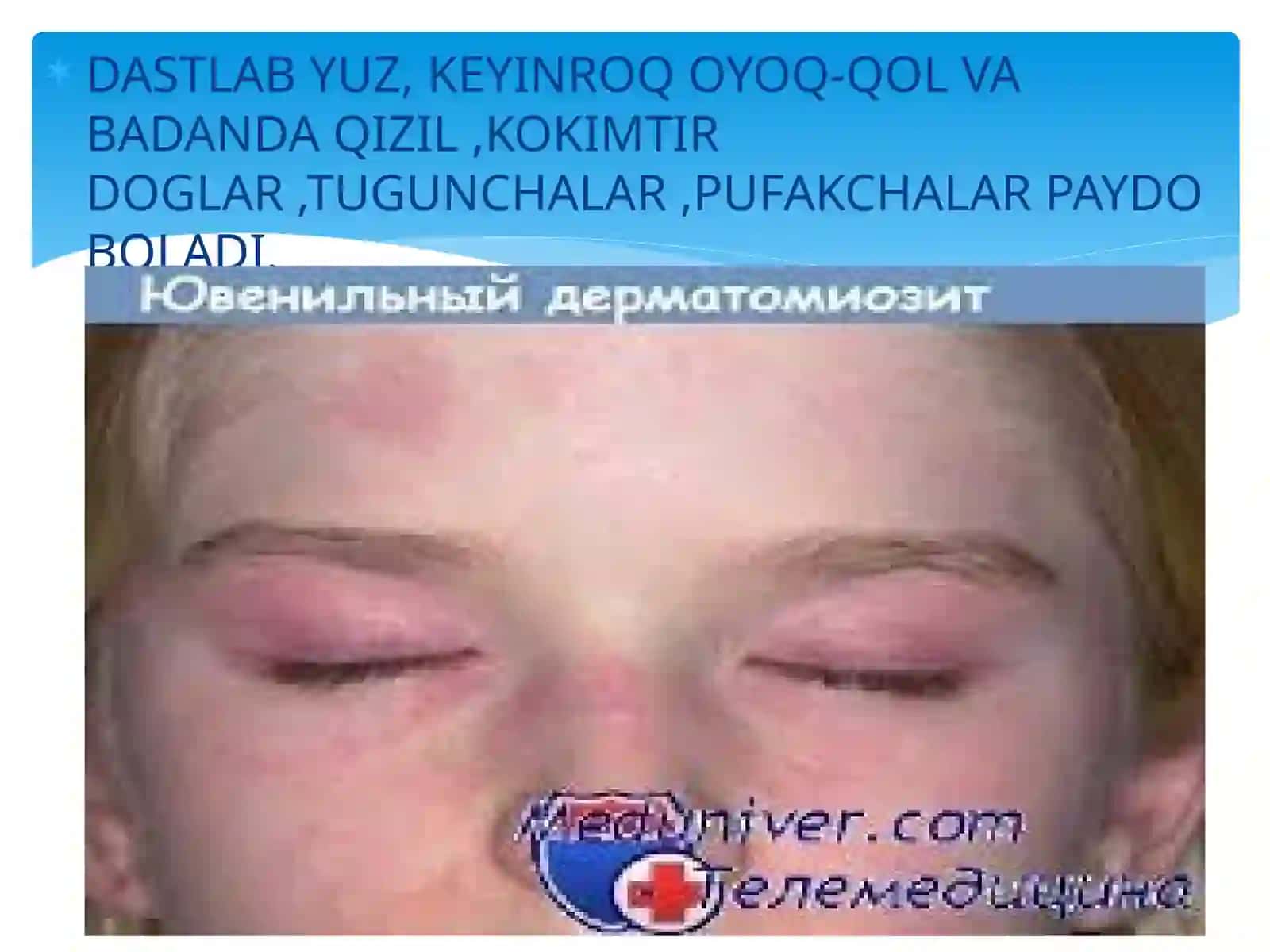 DERMATOMIOZITLAR 4