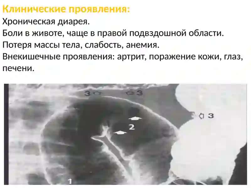 Болезнь Крона. Дисбактериоз кишечника. Болезнь Уиппла. Синдром раздражённого кишечника. 4