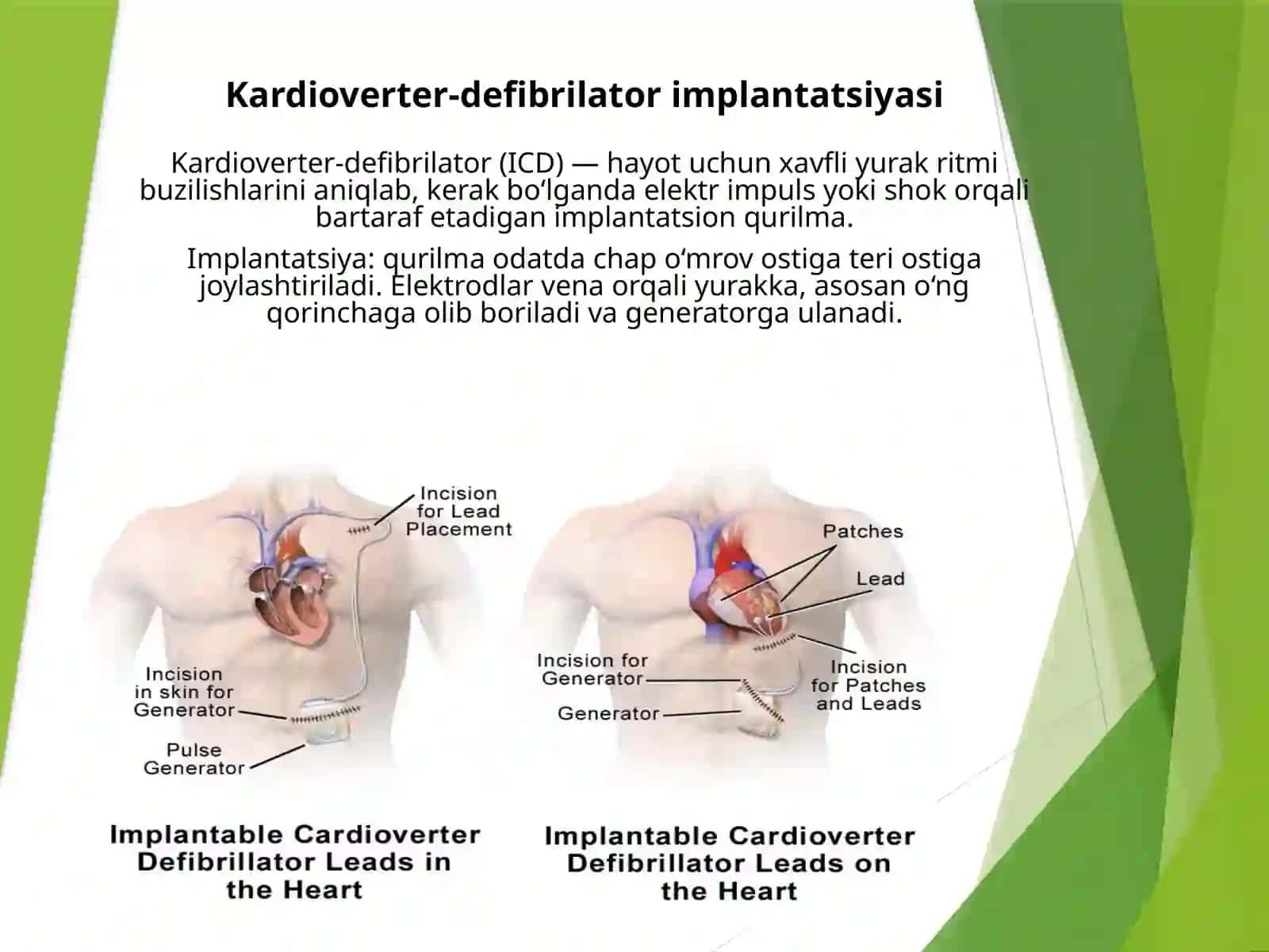 Kardioverter-defibrilator implantatsiyasiga bo‘lgan ehtiyojni baholash 4