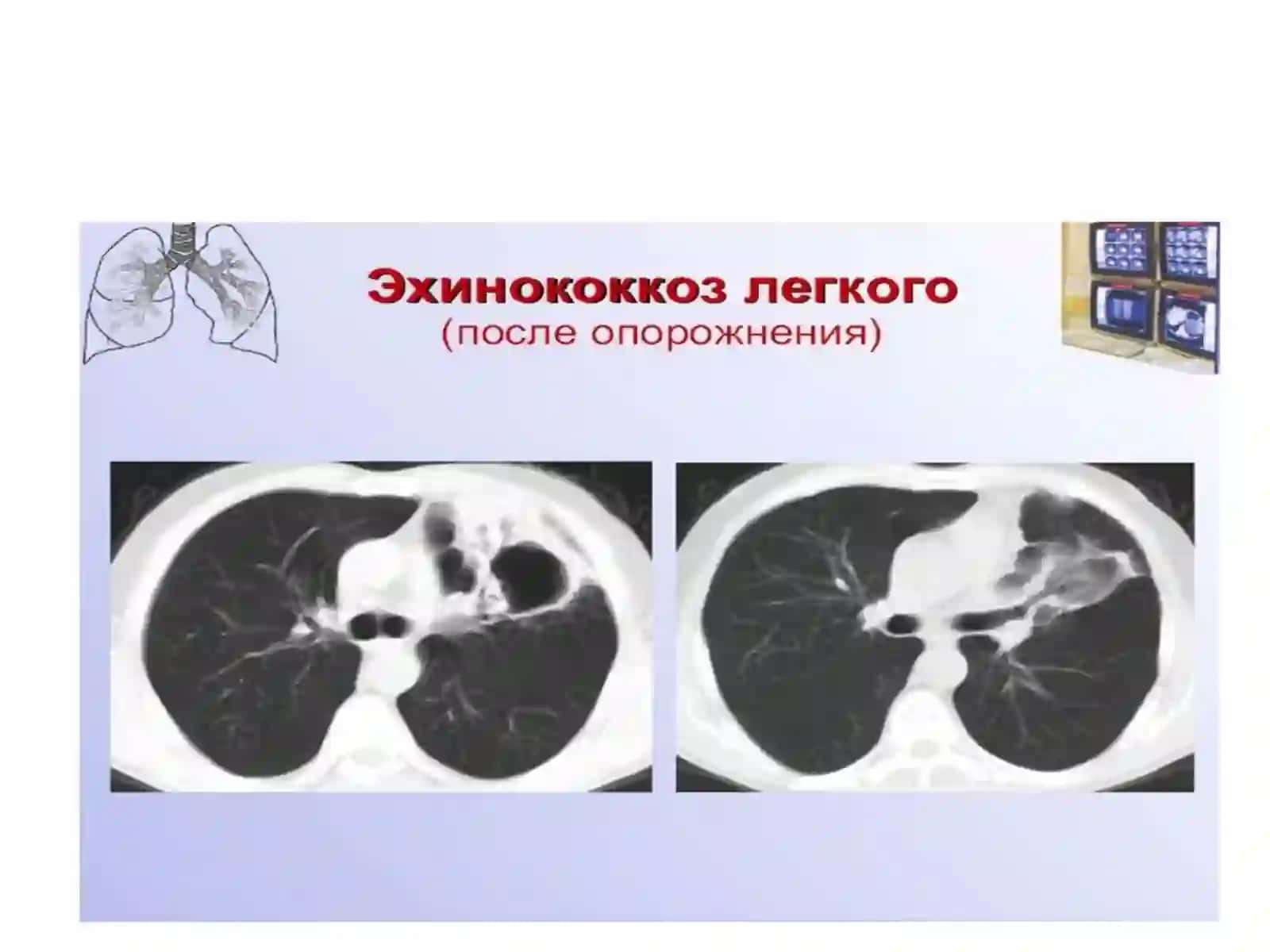 Exinokokkkista 4