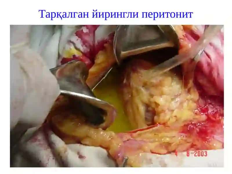 Перитонит 4