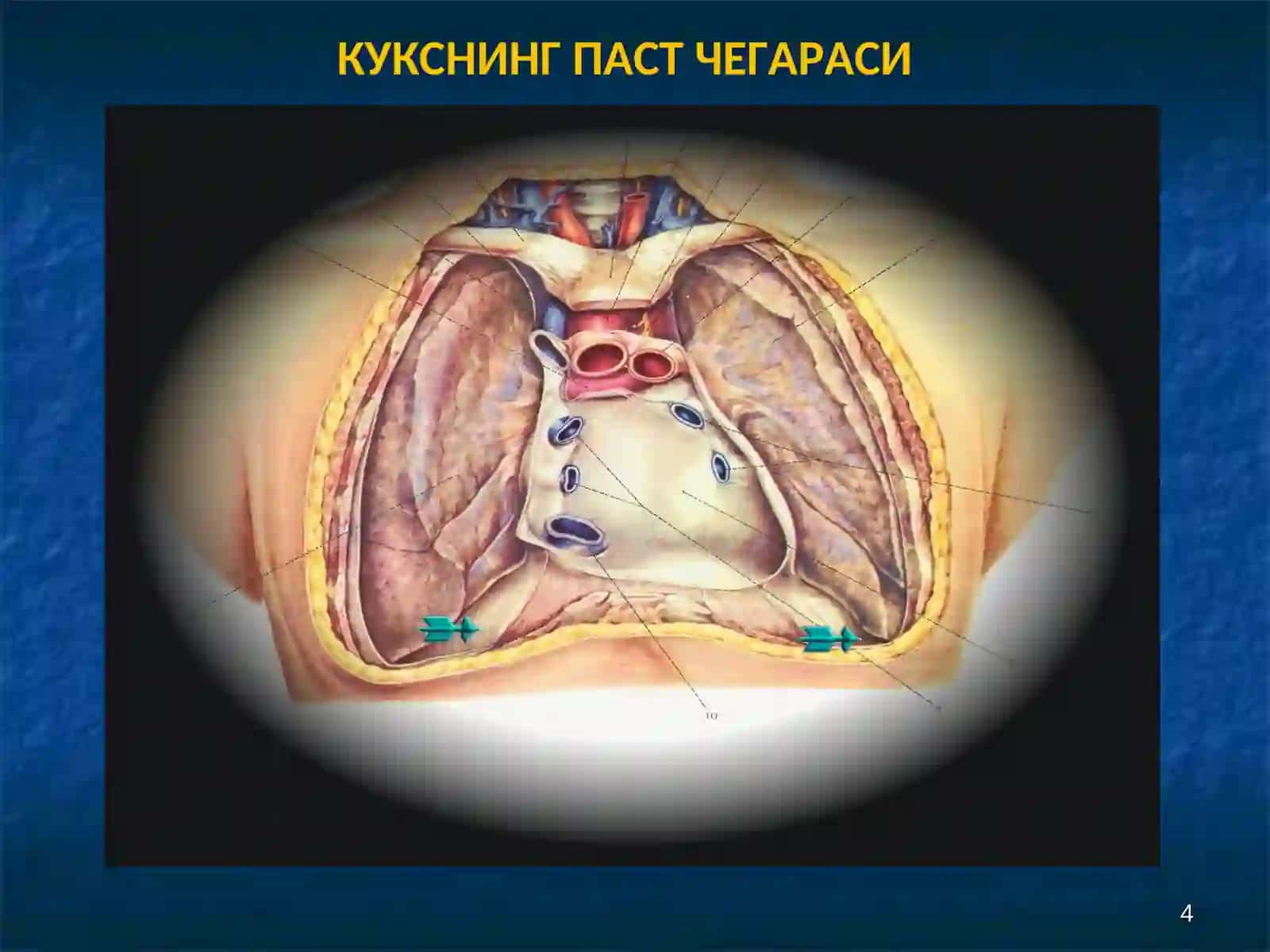 МЕДИАСТЕНИТ 4