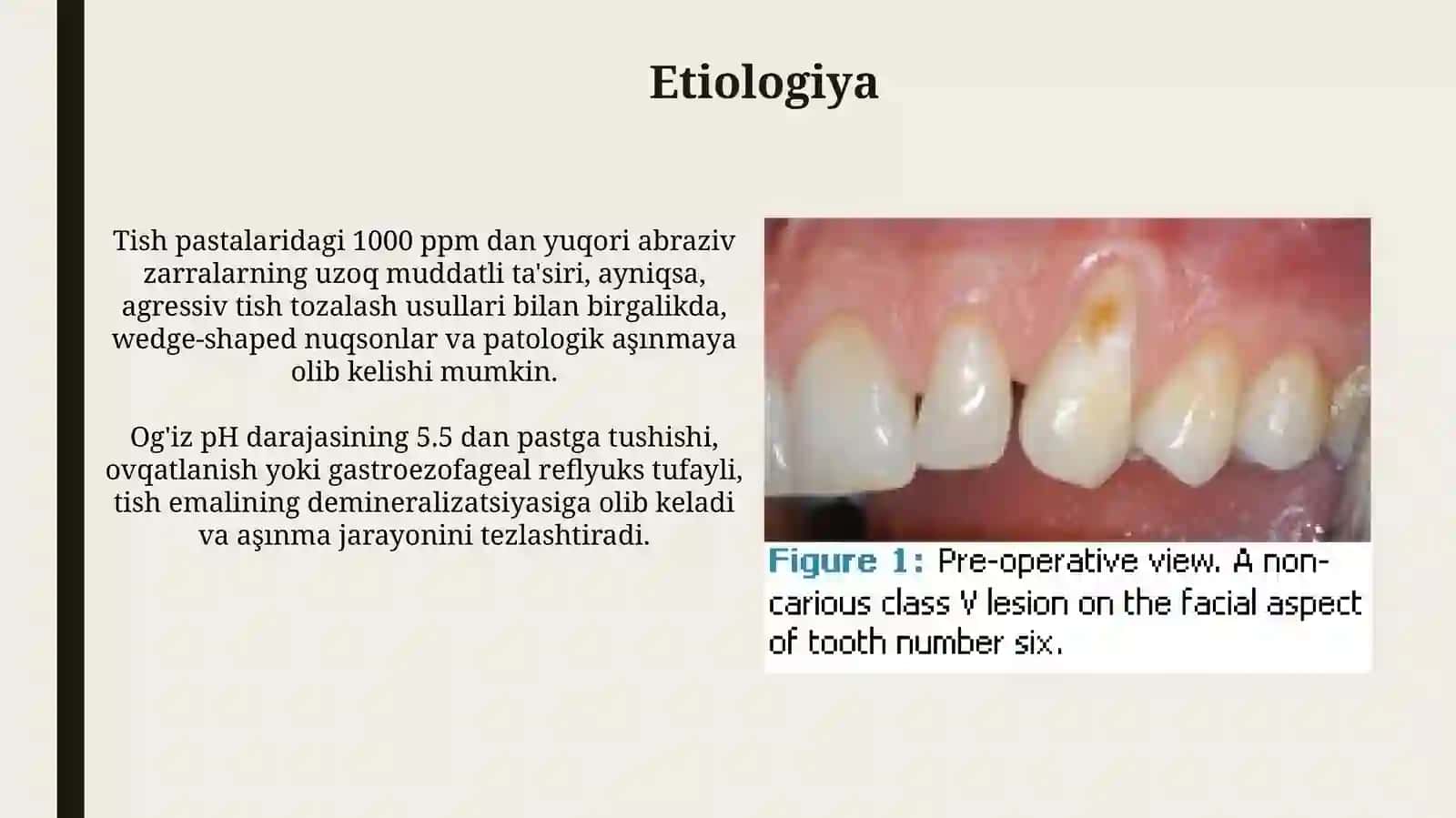 Tish chiqqandan keyin paydo bo'ladigan nokaries kasalliklari. Ponasimon nugson, patologik edirilish 4