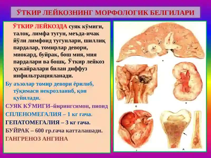 Анемия. Лейкоз 4