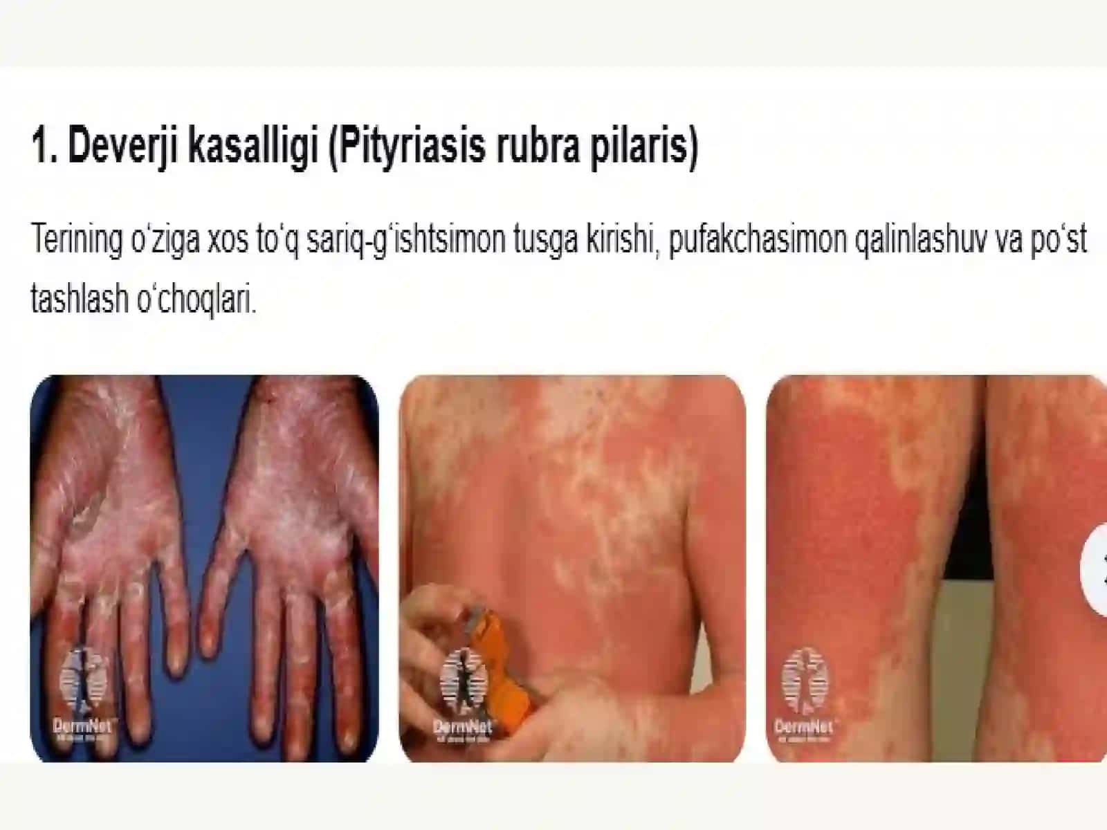Deverjikasalligi, Psoriaz va Qizilyassi temiratki 4