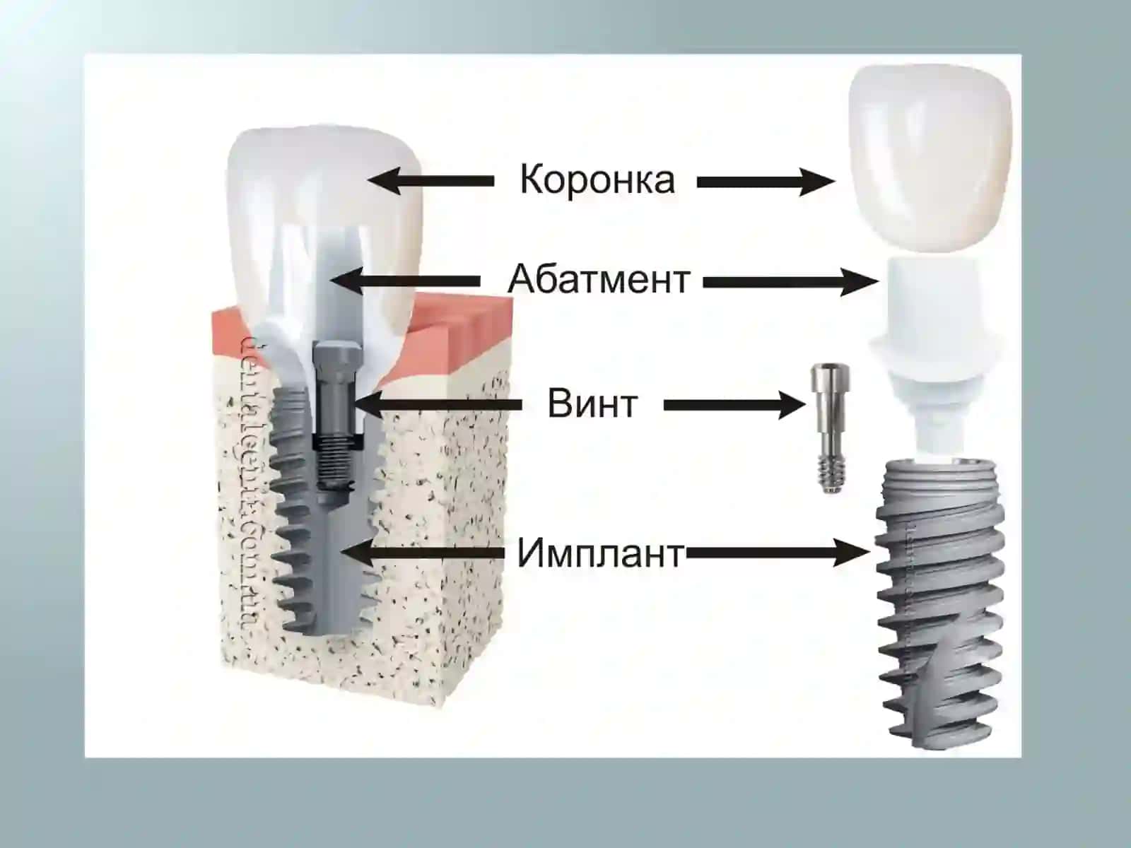 Implantlar asosidagi protezlar 4